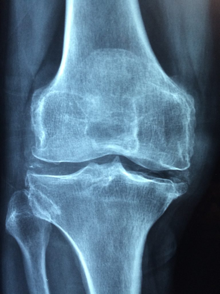 maladies féminines ostéoporose