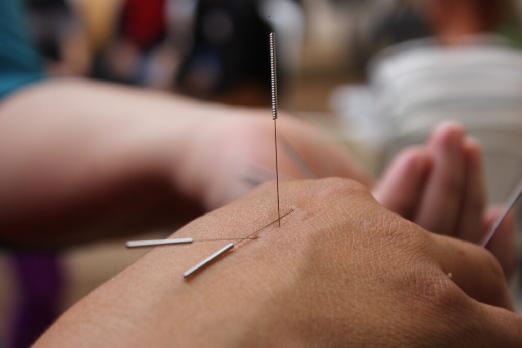 acupuncture pour arrêter le tabac